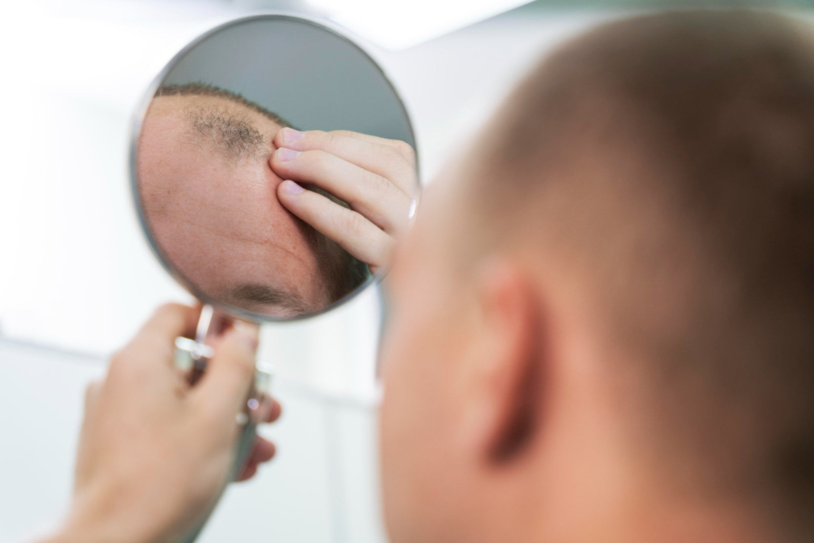male pattern baldness, cause of male hair loss